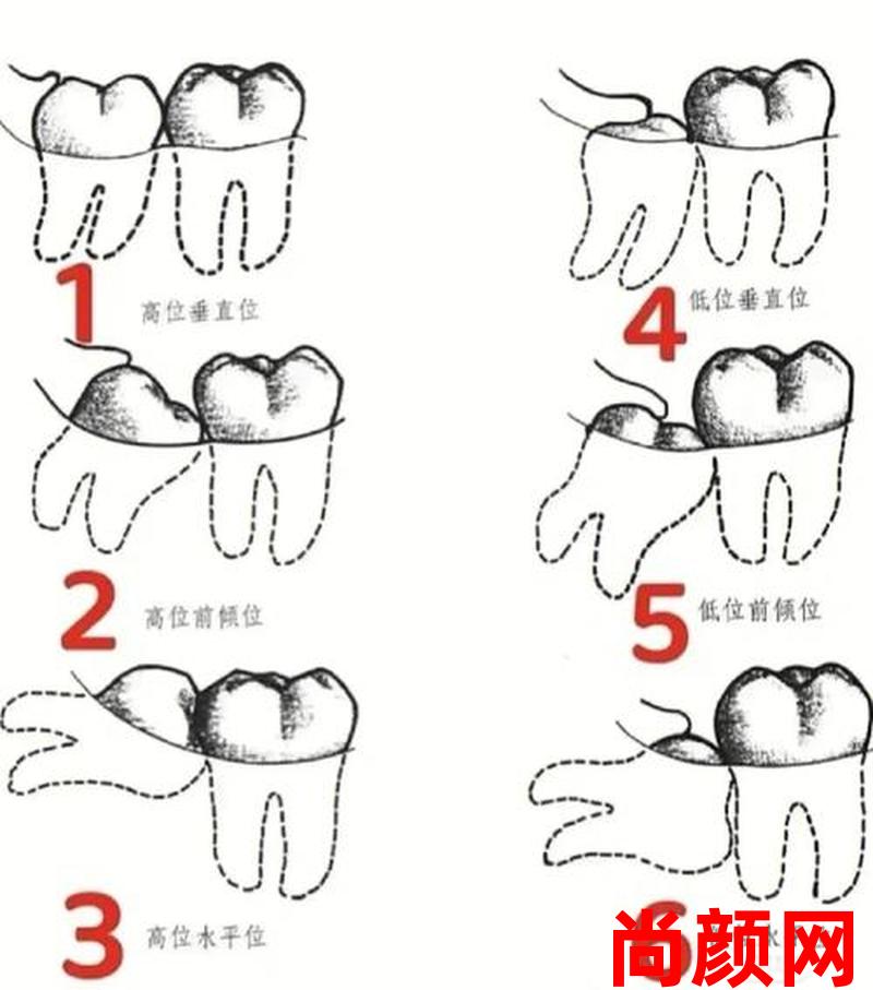 拔完智齿后多久可以刷牙;拔完智齿后多久可以刷牙漱口