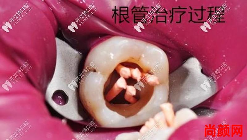 烂神经要多久_烂神经要多久才能补牙