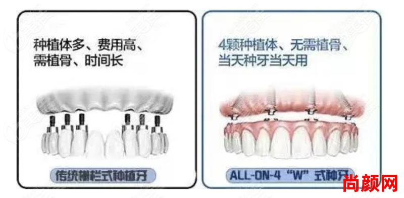 半口allon4种植牙什么时候(allon4种植牙半口种植多少颗)