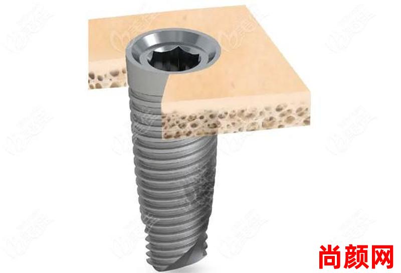 登士柏西诺德种植牙多少钱,登士柏西诺德种植体产品