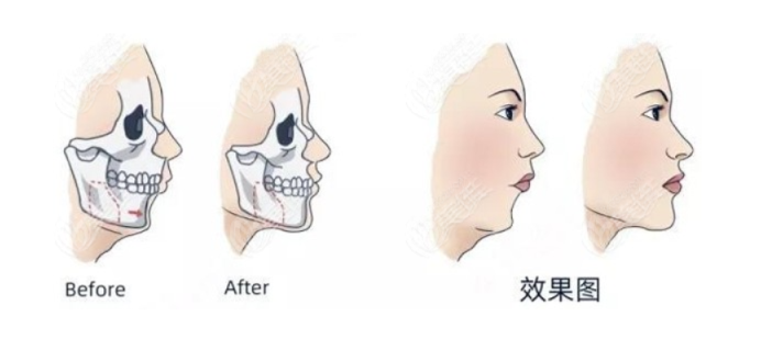 正颌手术大概花费多少钱，信息一览！