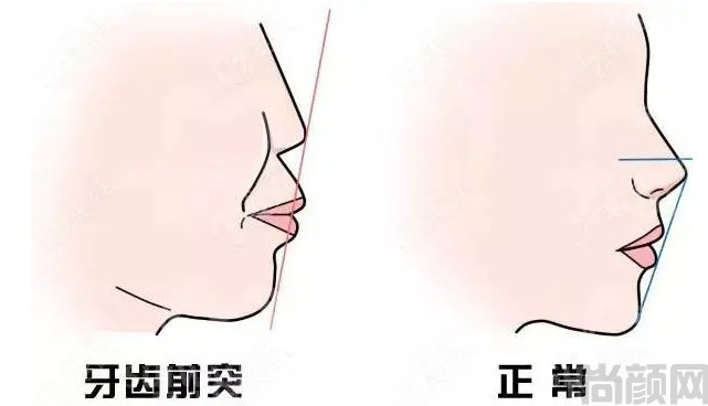 牙槽骨突出矫正方法,可以通过牙齿矫正器、牙齿矫正手术和正畸矫治等方法治疗