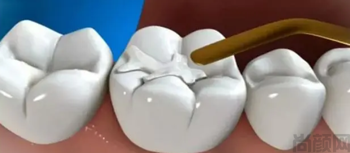 补牙做嵌体好还是直接补好?补牙和做嵌体的选择
