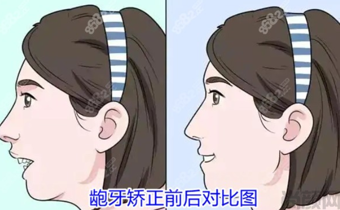 戴牙套可以矫正嘴唇前凸吗？戴牙套需要注意的事项