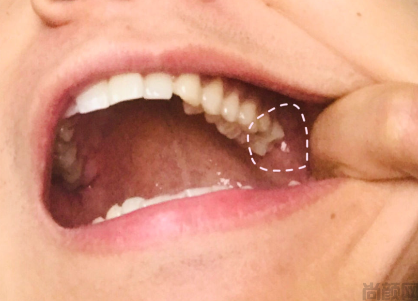 智齿上面有一块肉瓣很疼,该如何治疗？