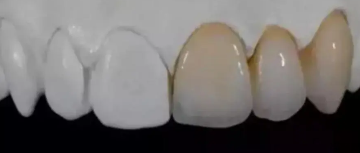 氧化锆全瓷牙多少钱一颗？如何选择氧化锆全瓷牙