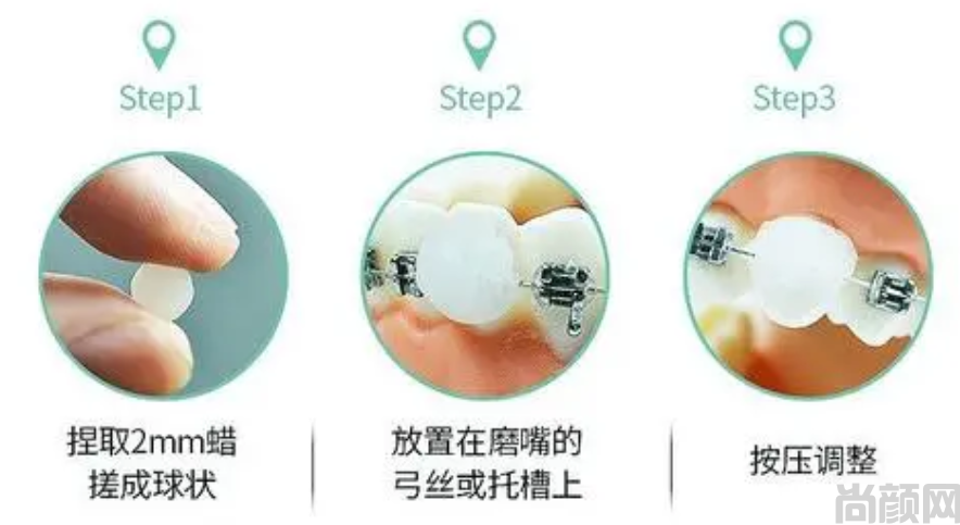 正畸蜡的使用方法,及注意事项(图1)