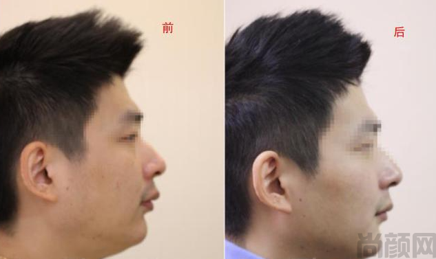 成人牙齿深覆合有必要矫正吗？