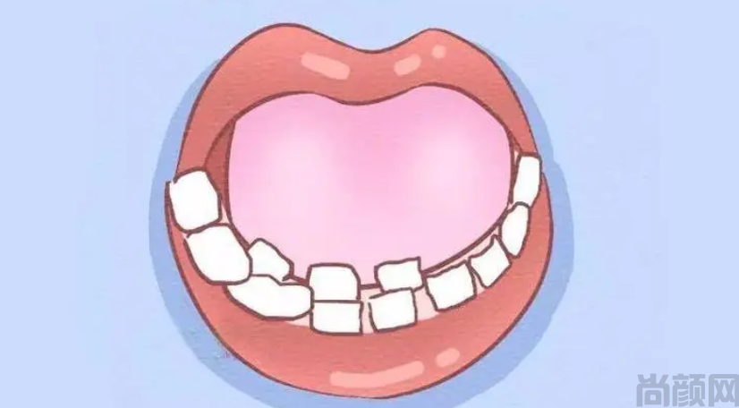 双排牙什么时候拔最好?双排牙拔除的时机(图1)