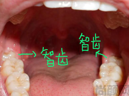 人的智齿最长有几厘米?长智齿的原因