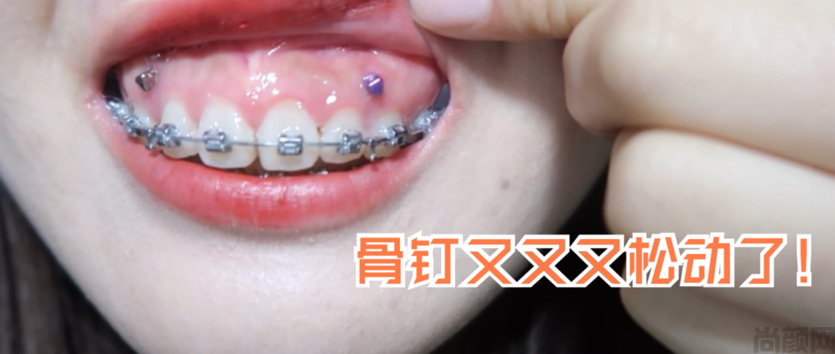 牙齿矫正骨钉要戴多久才能取？取牙骨钉后会留洞吗？