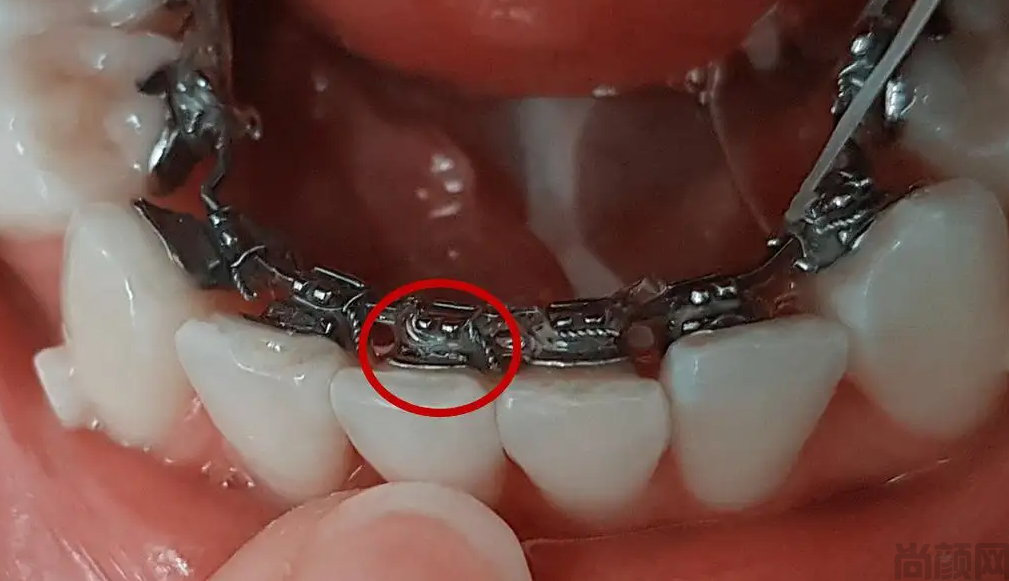 牙套橡胶圈挂法示意图,挂法方法(图1) 牙套橡胶圈挂法示意图,挂法方法(图1)