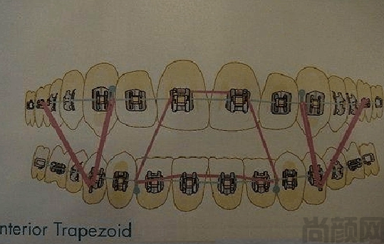 牙套橡胶圈挂法示意图,挂法方法(图2) 牙套橡胶圈挂法示意图,挂法方法(图2)