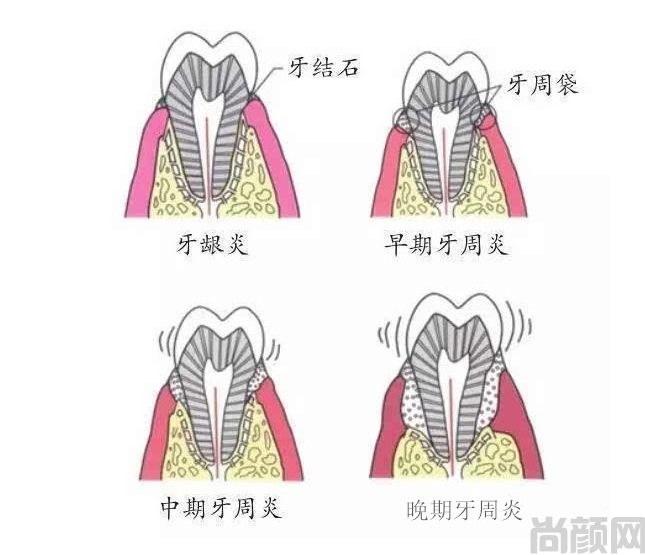 牙周袋深度三级分类，分别是轻度、中度和重度(图1)