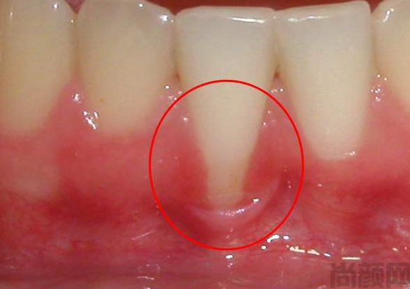 牙周袋深度三级分类，分别是轻度、中度和重度(图2)