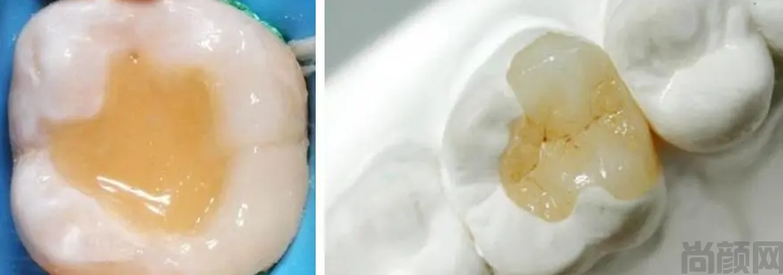 嵌体牙多少钱一颗? 嵌体牙的价格因素(图2) 嵌体牙多少钱一颗? 嵌体牙的价格因素(图2)