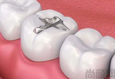 嵌体牙多少钱一颗? 嵌体牙的价格因素(图1) 嵌体牙多少钱一颗? 嵌体牙的价格因素(图1)