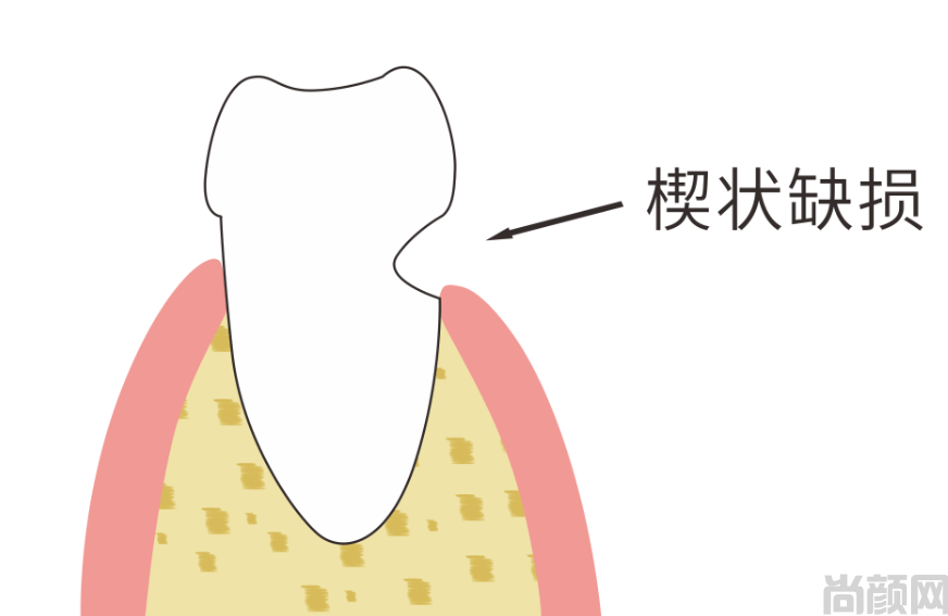 楔状缺损不要盲目补牙！楔状缺损需要补牙吗？(图2)