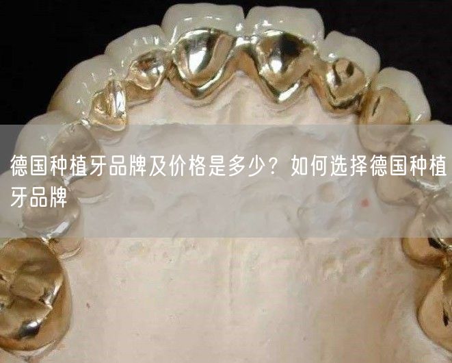 德国种植牙品牌及价格是多少？如何选择德国种植牙品牌