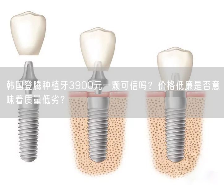 韩国登腾种植牙3900元一颗可信吗？价格低廉是否意味着质量低劣？