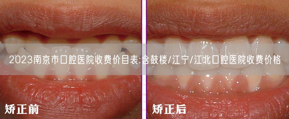2023南京市口腔医院收费价目表:含鼓楼/江宁/江北口腔医院收费价格