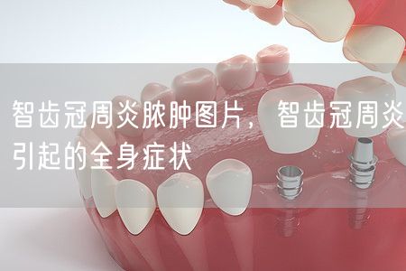 智齿冠周炎脓肿图片，智齿冠周炎引起的全身症状