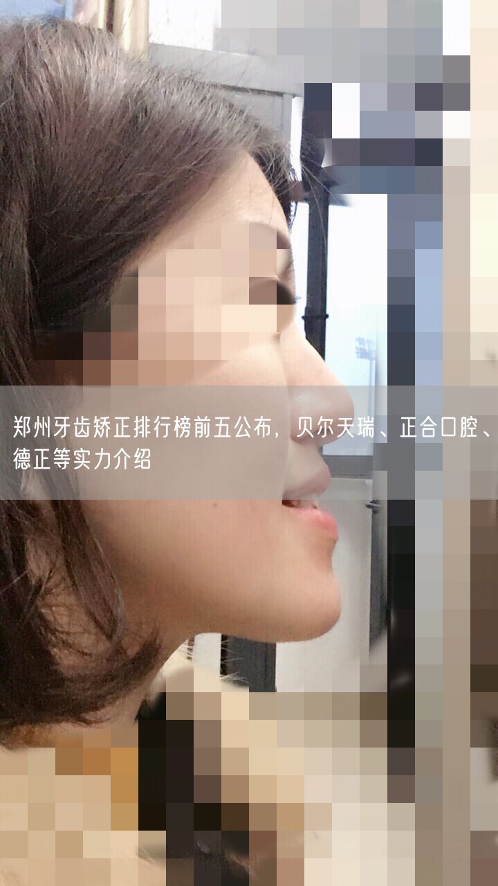 郑州牙齿矫正排行榜前五公布，贝尔天瑞、正合口腔、德正等实力介绍
