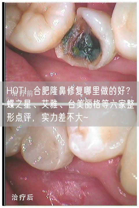 HOT！合肥隆鼻修复哪里做的好？蝶之星、艾雅、台美丽格等六家整形点评，实力差不大~
