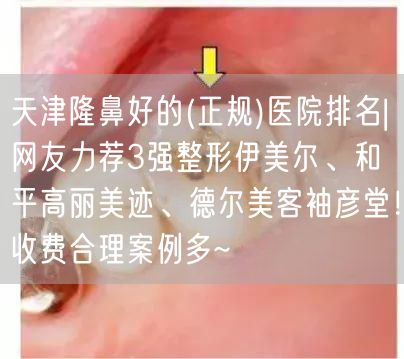 天津隆鼻好的(正规)医院排名|网友力荐3强整形伊美尔、和平高丽美迹、德尔美客袖彦堂！收费合理案例多~