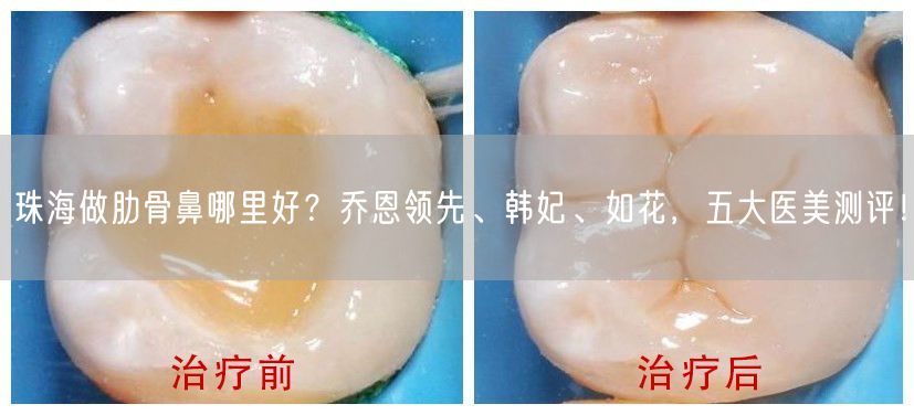 珠海做肋骨鼻哪里好？乔恩领先、韩妃、如花，五大医美测评！