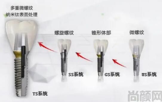 全新美国种植牙十大植体品牌及价格表已出炉!稳定性好