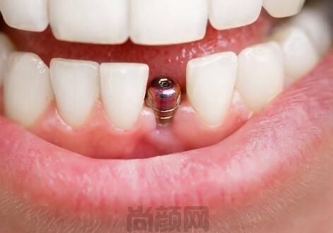 公布杭州萧山口腔医院种植牙多少钱一颗?附排名前十牙科排名