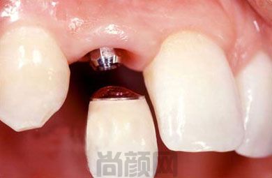 杭州雅莱齿科全新种植牙价格表已推出！附口碑和评价(图1)