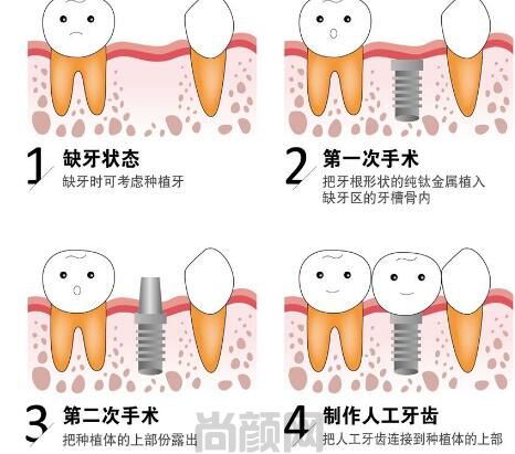 揭秘杭州英博口腔种植牙价格,附医生团队+特色技术分享