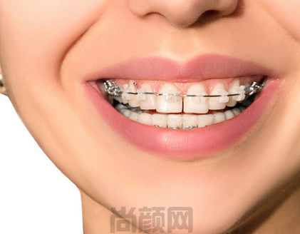 广州牙齿矫正多少钱