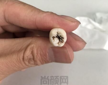 快看智齿发黑烂了的图片,表面一个小黑点里面早已烂完了!