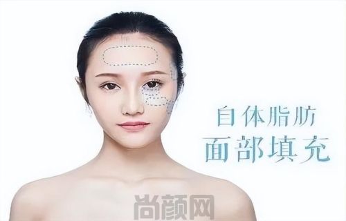 南京柏盛医疗美容医院怎么样？面部脂肪填充案例很成功(图2)