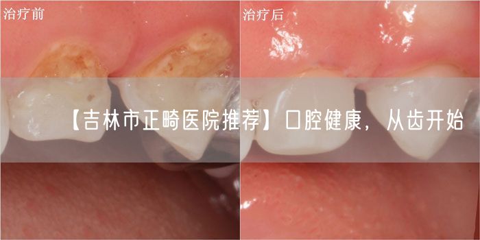 【吉林市正畸医院推荐】口腔健康，从齿开始