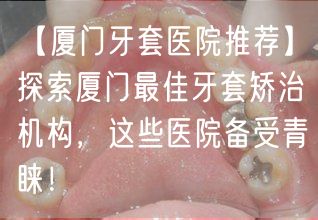 【厦门牙套医院推荐】探索厦门最佳牙套矫治机构，这些医院备受青睐！(图1)