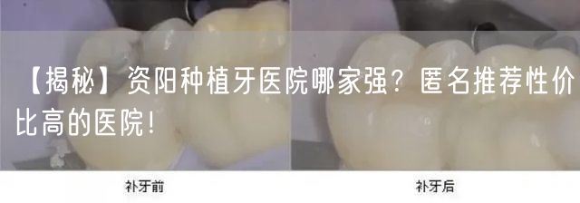 【揭秘】资阳种植牙医院哪家强？匿名推荐性价比高的医