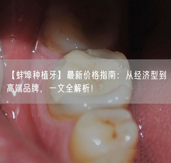 【蚌埠种植牙】最新价格指南：从经济型到高端品牌，一文全解析！