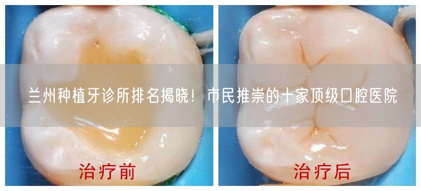 兰州种植牙诊所排名揭晓！市民推崇的十家顶级口腔医院
