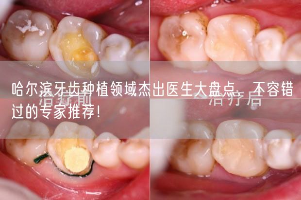 哈尔滨牙齿种植领域杰出医生大盘点，不容错过的专家推荐！
