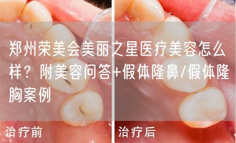 郑州荣美会美丽之星医疗美容怎么样？附美容问答+假体隆鼻/假体隆胸案例