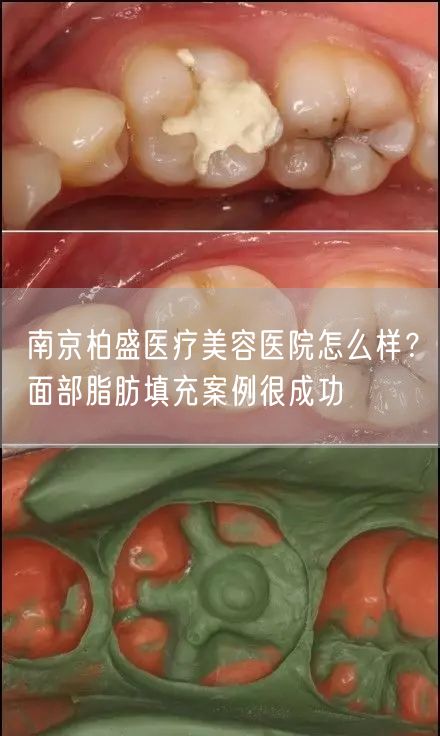 南京柏盛医疗美容医院怎么样？面部脂肪填充案例很成功