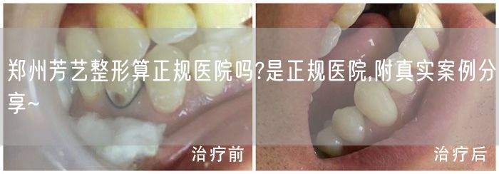 郑州芳艺整形算正规医院吗?是正规医院,附真实案例分享~