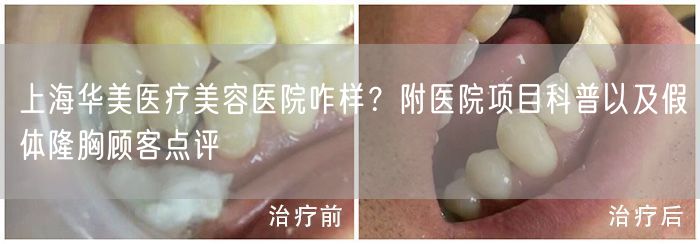 上海华美医疗美容医院咋样？附医院项目科普以及假体隆胸顾客点评