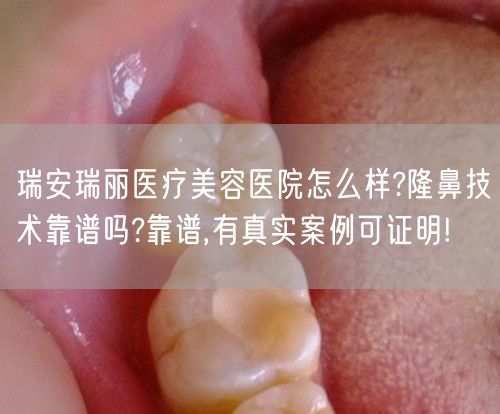 瑞安瑞丽医疗美容医院怎么样?隆鼻技术靠谱吗?靠谱,有真实案例可证明!