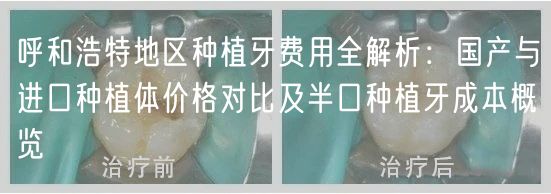 呼和浩特地区种植牙费用全解析：国产与进口种植体价格对比及半口种植牙成本概览(图1)