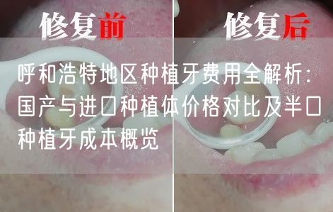 呼和浩特地区种植牙费用全解析：国产与进口种植体价格对比及半口种植牙成本概览